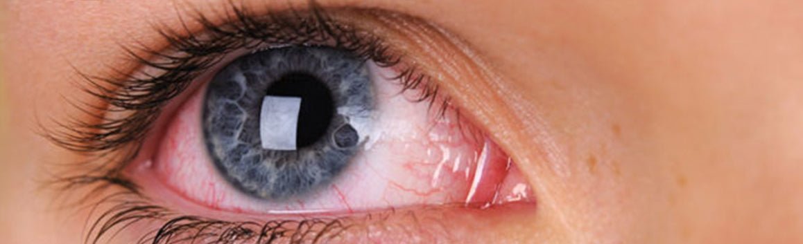 Does CBD Make Your Eyes Red?